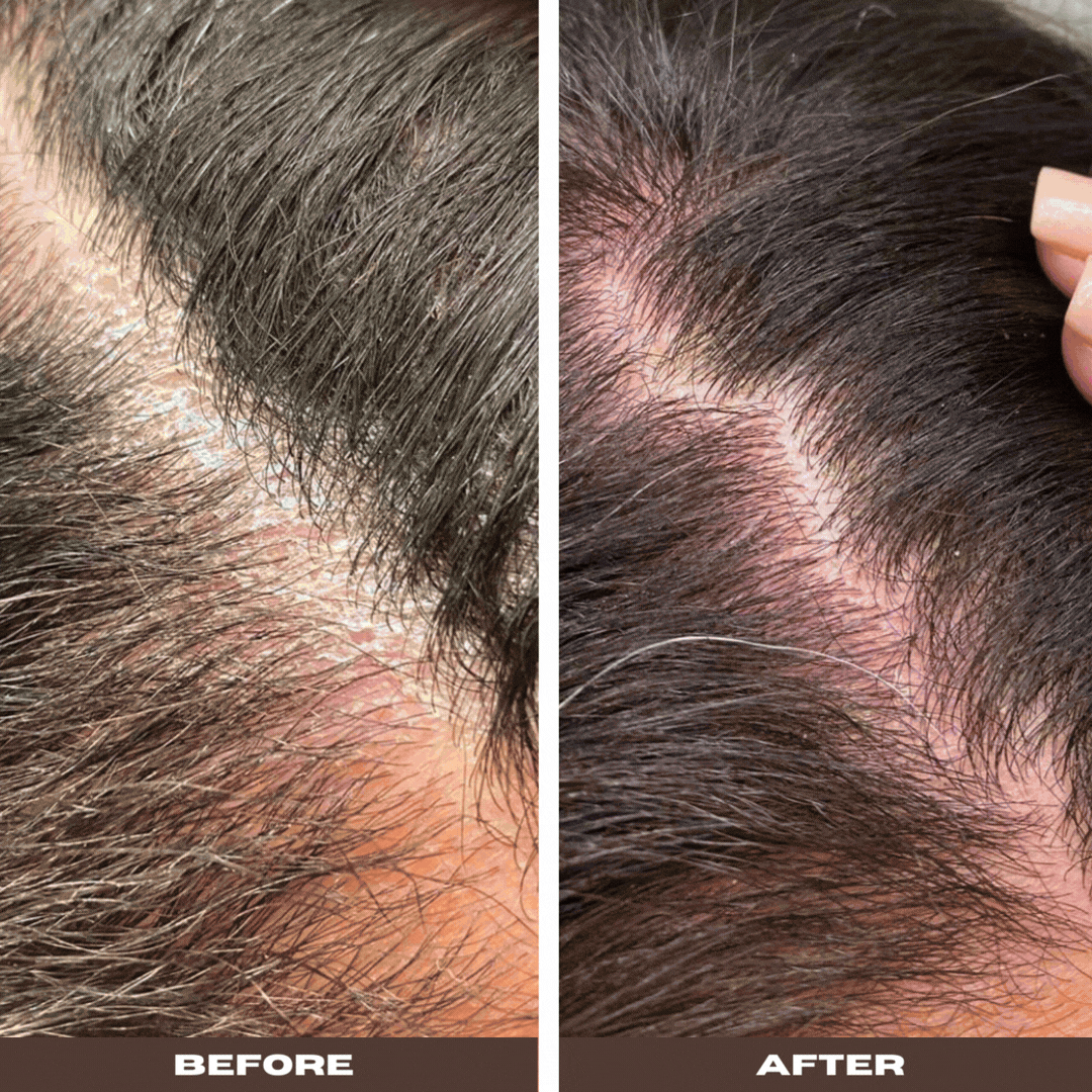 Seborrheic Scalp Solution | Herbal Leave-in | YeastDefense®️