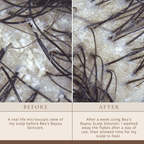 Seborrheic Scalp Solution | Herbal Leave-in | YeastDefense®️